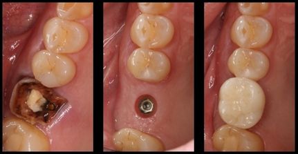 Stages of a dental implant procedure: decayed molar, implant post, and completed crown.