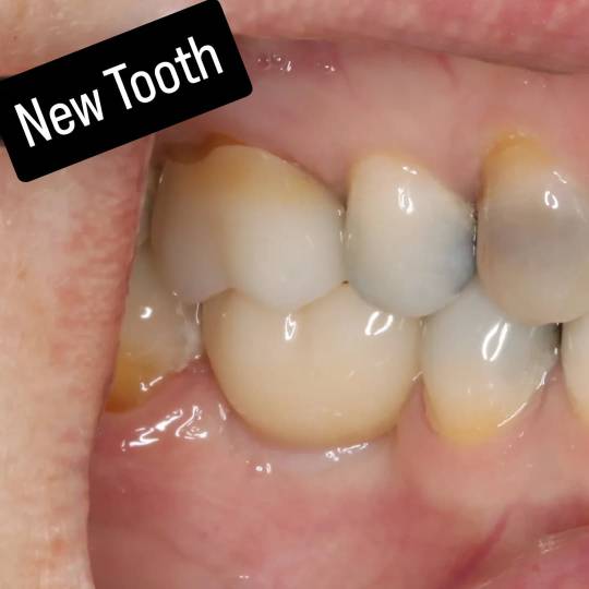 Tooth after dental implant