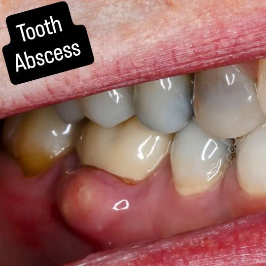 Tooth before dental implant