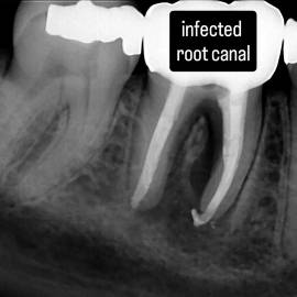 Step 1: Infected root