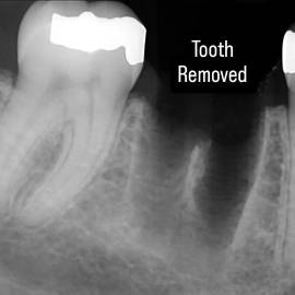 Step 2: Tooth removed