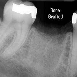 Step 3: Bone grafted