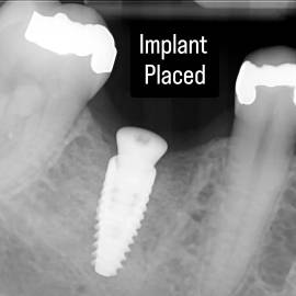 Step 4: Implant placed