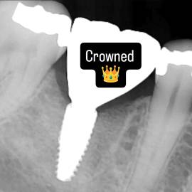 Step 5: Crown placed